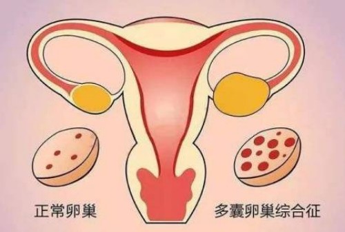 子宫腺肌症也有规定标准，没达到要求可不用手术